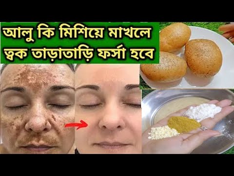 ফেসিয়াল এর চেয়ে ১০ গুন গ্লো একদিনে ত্বকের কালো দাগ ময়লা তুলে ত্বক দুধের মত ফর্সা হবে/Curd facial