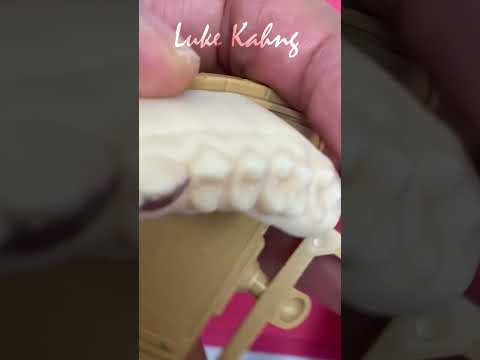 Replacing two, individual missing teeth directly from an .stl file