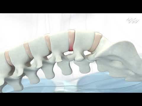 BTL Spinal Decompression -  Mécanisme d'action