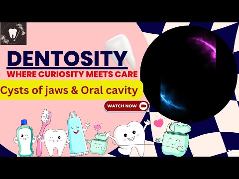 Cysts of jaws & oral cavity