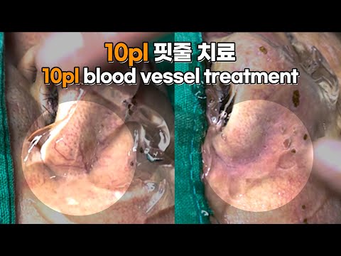 10pl 핏줄 치료 10pl blood vessel treatment