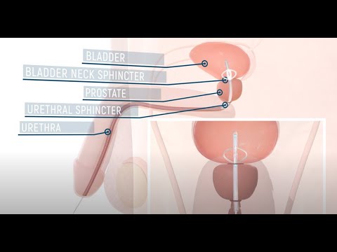 Flat Medical UroAid-IV urinary catheter - 3D medical animation