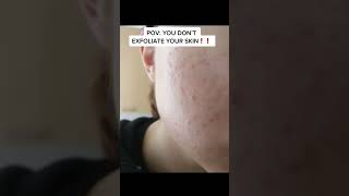 POV: YOU NEVER EXFOLIATE YOUR SKIN!! #skincareroutine #skincare