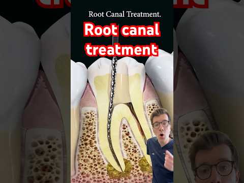 Doctor explains Root Canal treatment #shorts #dental