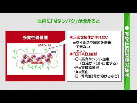 2022年1月29日放送　沢井製薬プレゼンツ　正しく理解しよう「血液がん」③多発性骨髄腫