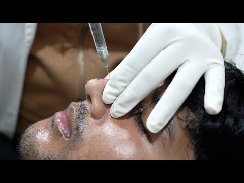 Reshaping the Nose with Liquid Rhinoplasty | Non-Surgical Nose Job