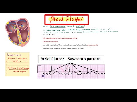 Atrial Flutter