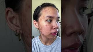 Acne journey #fyp #acnetreatment #skincare #fyp #clearskin #skintok #shorts #ytshorts #youtubeshorts