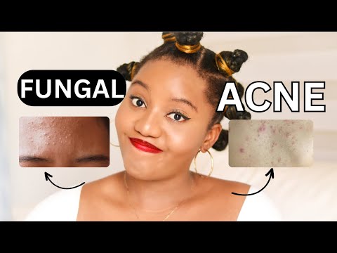 What is Fungal Acne? | How to Get Rid of Fungal Acne? | Fungal Acne Treatments