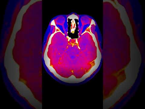 Neanderthal Brains Were Different