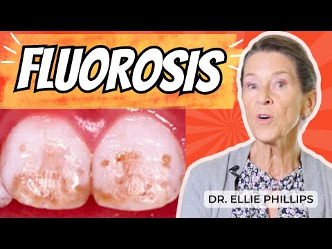 Dental Fluorosis Explained: What Causes Those Spotted Teeth?