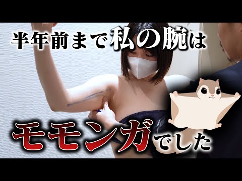 ボコボコ一切なし！これで脂肪吸引したってわかりますか？ 【二の腕の脂肪吸引】