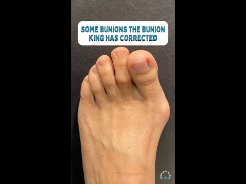 Now these are BIG BOY BUNION! #bunion #bunioncorrection