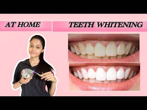 DIY Teeth Whitening at home🤍