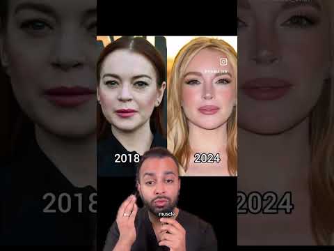 What Cosmetic Work Has Lindsay Lohan Had? - Dr Somji Viewpoint