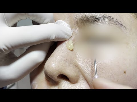 필러제거 시술영상(Filler removal procedure)