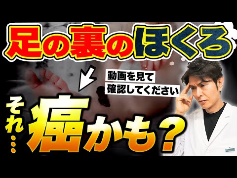 【大丈夫？】その ほくろ は 皮膚がん なのかセルフチェック！ 足の裏のほくろ は除去した方がいいのか見分け方について