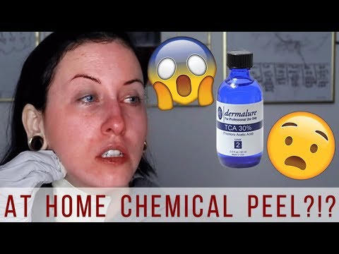 How to Do a TCA Peel at Home | TCA 30% Chemical Peel | Before & After Results