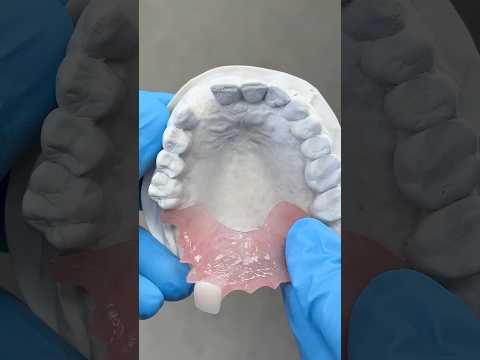 Replacing a Lateral Incisor with an AcryGrip Partial #lsk121shorts #dentist #teeth