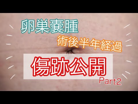 【卵巣嚢腫】術後半年経過しました！傷跡公開Part２！