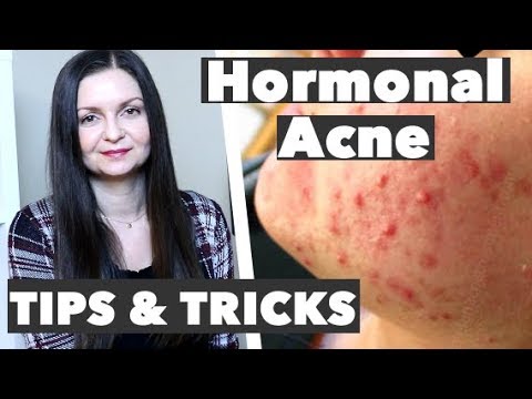 How to Get Rid of Hormonal Acne - Best Remedy for Premenstrual Breakouts - Cure Hormonal Acne