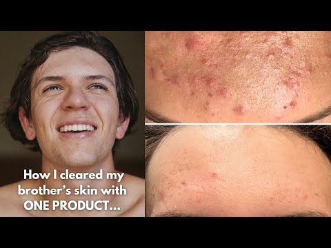 How I Cleared My Brother's Acne, Texture, & Clogged Pores With One Product | Jadeywadey180