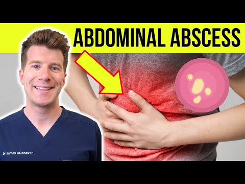 Doctor explains Abdominal Abscess | Causes, Symptoms, Diagnosis