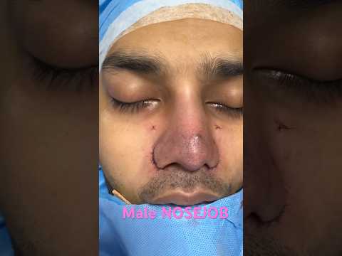 Best Male cosmetic Augmentation Nosejob in India