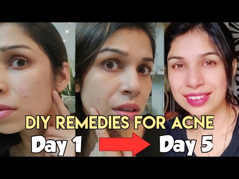 5 Days Challenge | How to Get rid of Pimples & Acne | Home Made Toner & Ointment | Skin Care Tips