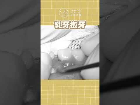 小朋友乳牙怎麼正確拔除？｜【祐民牙醫－隱適美旗艦店】鑽石級楊大為醫師 #乳牙拔牙 #拔牙 #祐民牙醫