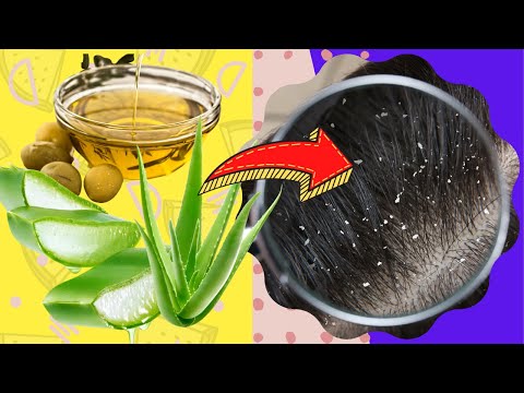 Dandruff - Top 10 Home Remedies for Dandruff