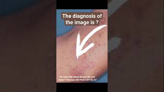 Lichen Planus : What you need to know for NEXT PG and Grand Test #next #neetpg