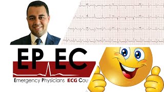 #EPEC ECG Cases (Case 06). How to interpret ANY ECG in 6 steps.