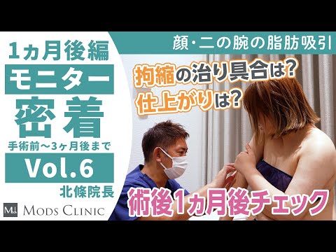 【モニター完全密着】気になる拘縮の様子は？「術後1ヶ月検診」編（第6話）/カウンセリング〜手術後3ヶ月の経過まで全て公開！/北條誠至 院長｜Mods Clinic モッズクリニック（脂肪吸引・注入）