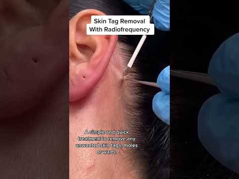 Skin Tag Removal With Radiofrequency  - DrMedispa