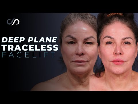 Transformation of Deep Plane Face and Neck Lift: RESULTS Revealed