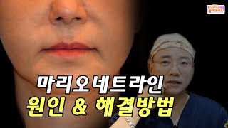 마리오네트주름(입가주름,심술보) 원인 그리고 해결방법