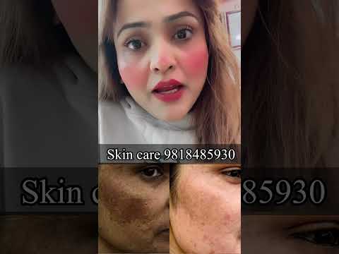 Skin care 9818485930#pigmentation  #skincare #acne #antiaging #skin #beauty