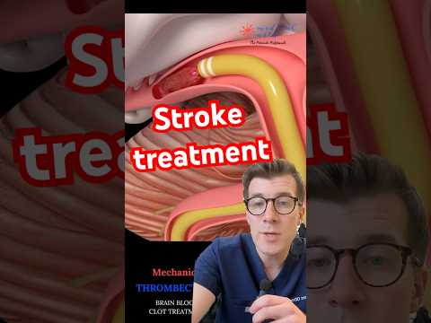 Doctor explains STROKE TREATMENT - clot removal #shorts