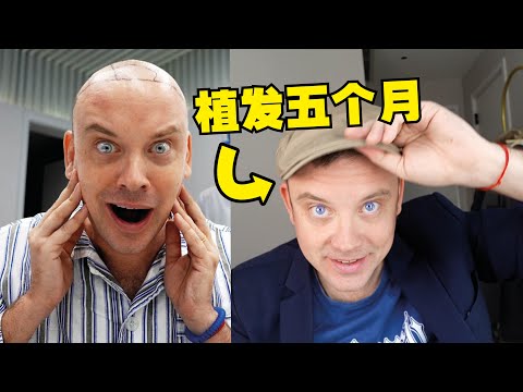 我在中国植发5个月, 效果怎么样? 现在揭秘！