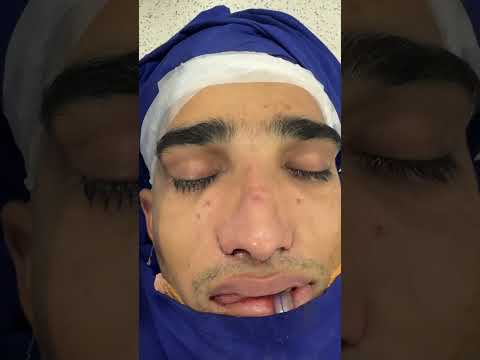 Deviated redo male nose job cosmetic surgery in India - bride and after at Richardsons Face