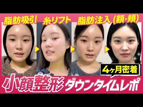 【小顔整形ダウンタイム】「ダイエットをしても顔だけ脂肪が落ちない」24歳スタッフさんの脂肪吸引ダウンタイムに密着！【脂肪吸引】【額の脂肪注入】【糸リフト】