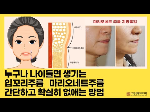 누구나 나이들면 생기는 입꼬리주름, 마리오네트주름 간단하고 확실히 없애는 방법 알이보기