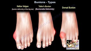 Bunions Types - Everything You Need To Know - Dr. Nabil Ebraheim