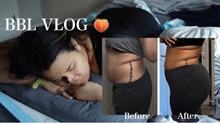 I GOT A BBL 🍑 Raw & Uncut first 3 days after a bbl & lipo 360 | BBL VLOG