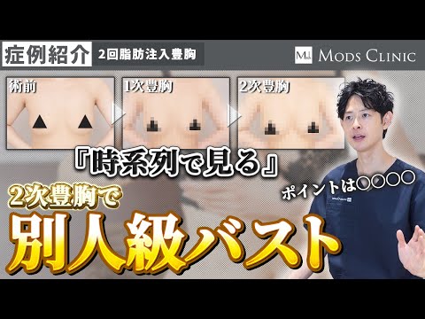 【症例紹介】脂肪豊胸で「失敗」しないこだわりのデザインとサイズアップを時系列で/吉江秀和 医師｜Mods Clinic モッズクリニック（脂肪吸引・注入）