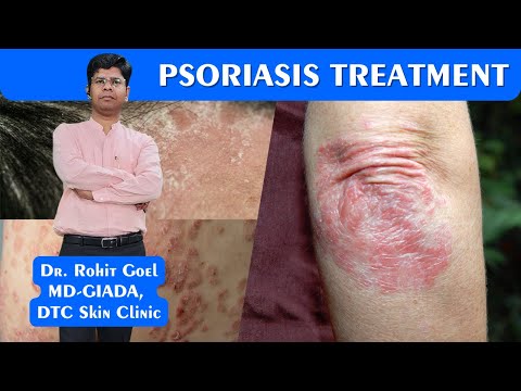 Psoriasis Treatment Patient Review | Dr. Rohit Goel