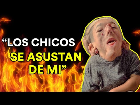 VIVIR SIENDO DEFORME (Entrevista a Matías Fernández)