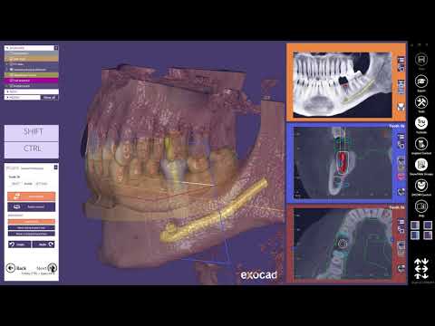 exocad Quick Guide Get most out of guided surgery