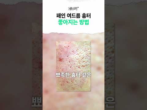 패인 피부도 매끈해질 수 있을까요? #여드름흉터#패인피부#프락셀